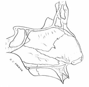 Tabique nasal formado por su porción cartilaginosa (septum) y ósea (hueso vómer y lámina perpendicular del etmoides).