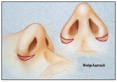 Escisión de Weir cutánea para estrechamiento de base alar y acortamiento de aletas nasales.