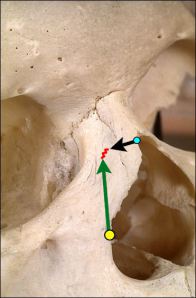 Osteotomía Baja-Baja para estrechamiento de dorso óseo en su base.