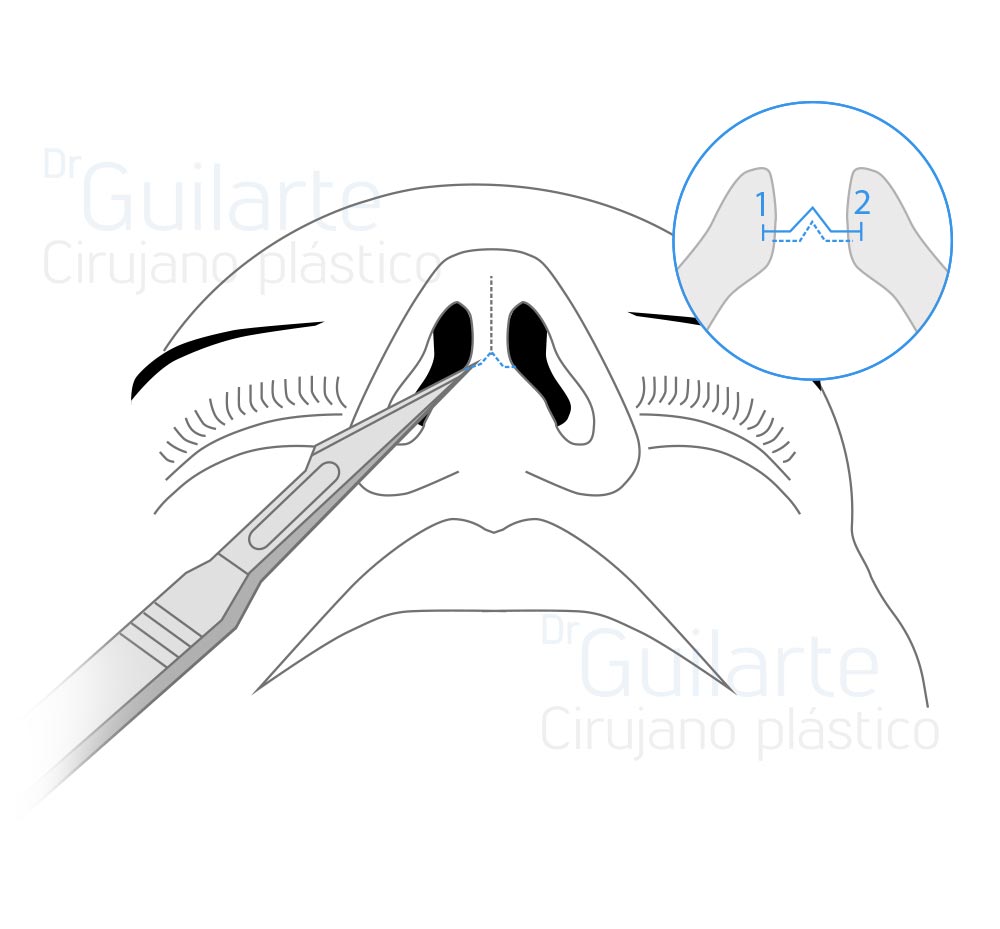 Rinoplastia abierta, tipos de rinoplastia (Dr Guilarte)