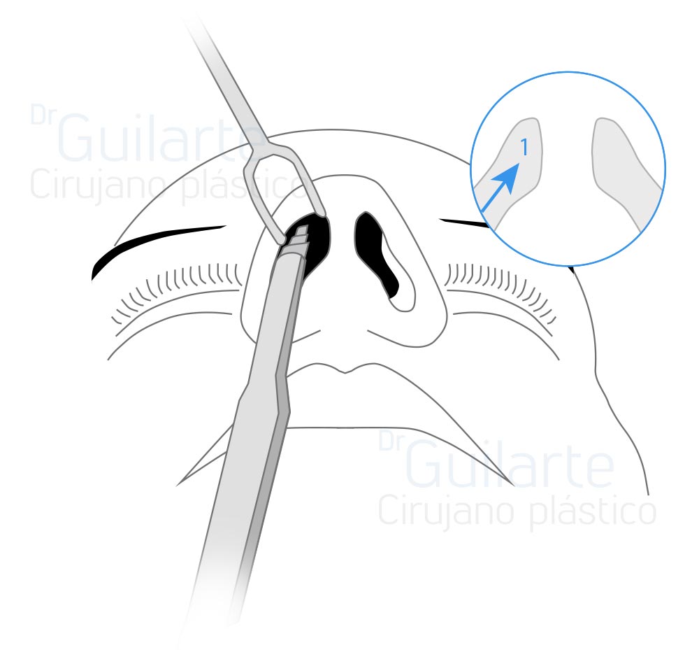Rinoplastia cerrada, tipos de rinoplastia (Dr Guilarte)
