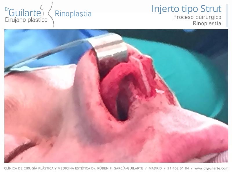 drguilarte-rinoplastia-injerto-nasal-tipo-strut-columelar-proyeccion-nariz-rinoplastia-madrid