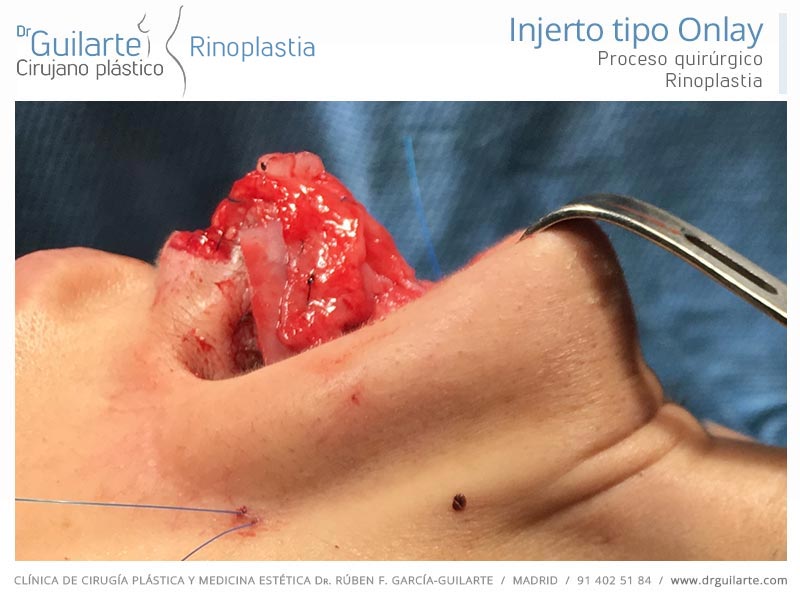 drguilarte-rinoplastia-injerto-tipo-onlay-1