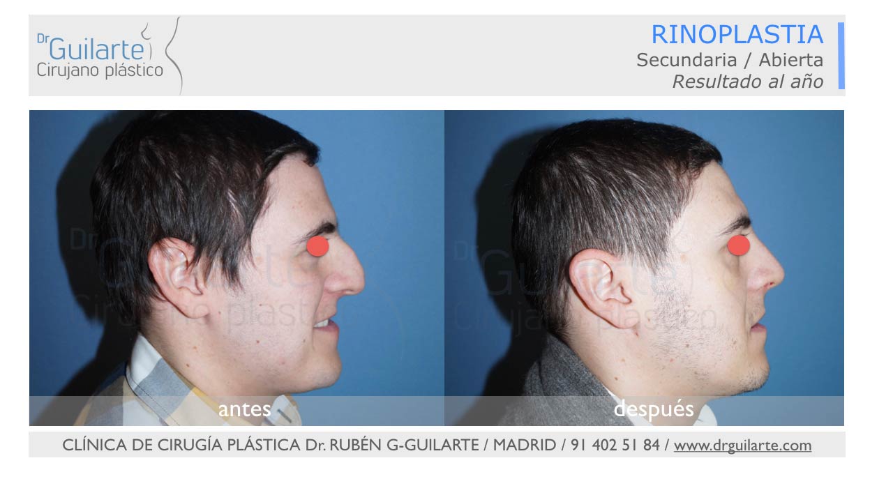 mejores-resultados-rinoplastia-cirugia-nariz