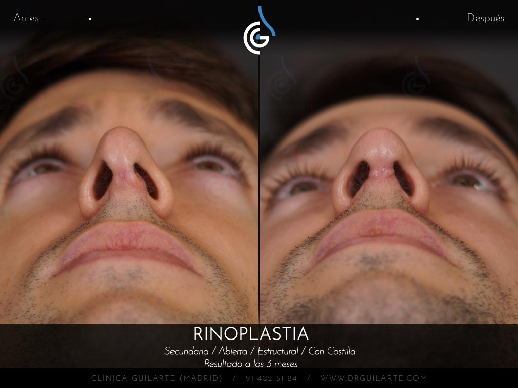 foto-1-cirugia-secundaria-en-paciente-con-el-dorso-nasal-amputado-que-se-ve-convexo-pinzamiento-exagerado-punta-nariz-hiperproyectada-desviada-y-con-retraccion-alar