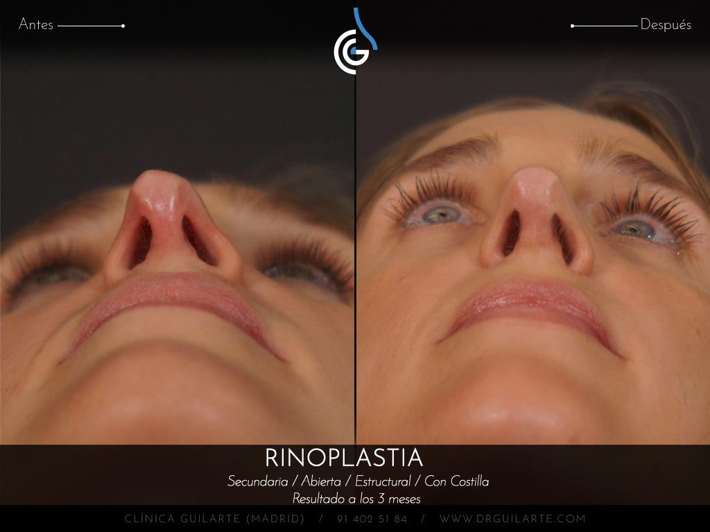 foto-punta-asimetrica-en-una-rinoplastia-segunda-intervencion-con-costilla-1de2